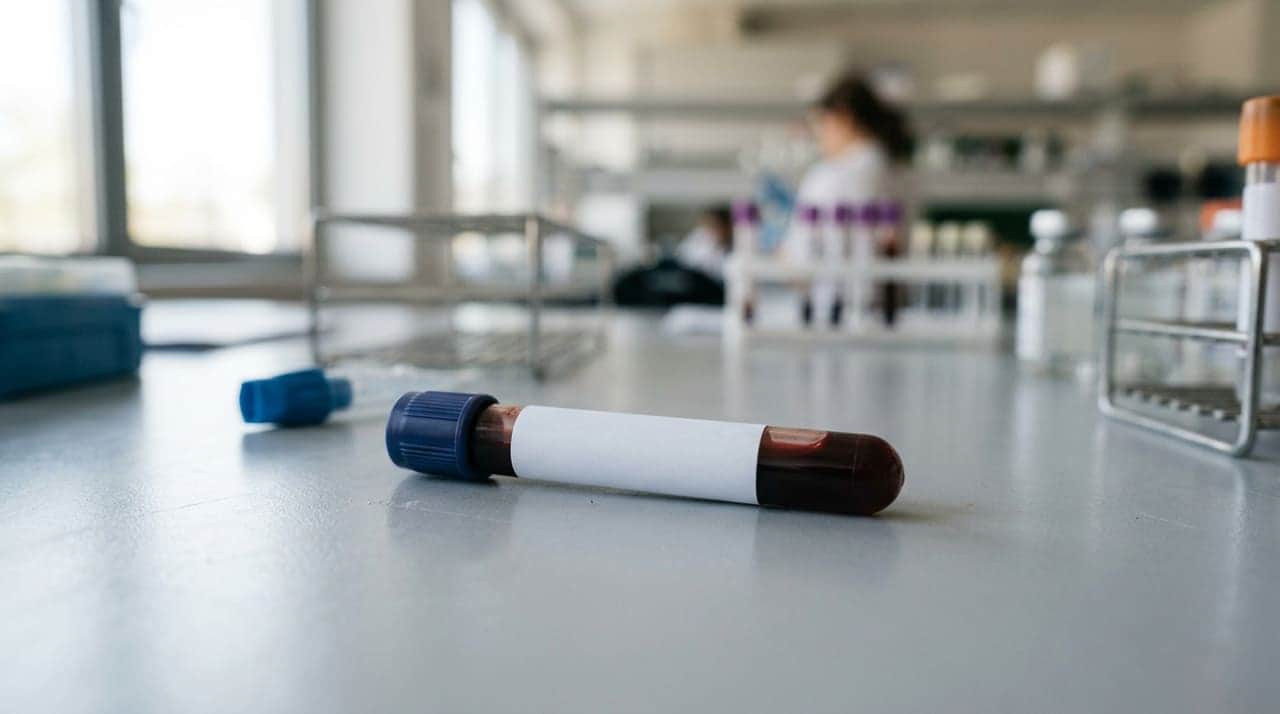 Tubo de coleta de sangue com etiqueta de exame de ácido úrico sobre bancada de laboratório em luz neutra